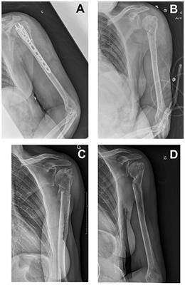 Case report: Continuous infusions of ceftazidime-avibactam and aztreonam in combination through elastomeric infusors for 12 weeks for the treatment of bone and joint infections due to metallo-β-lactamase producing Enterobacterales